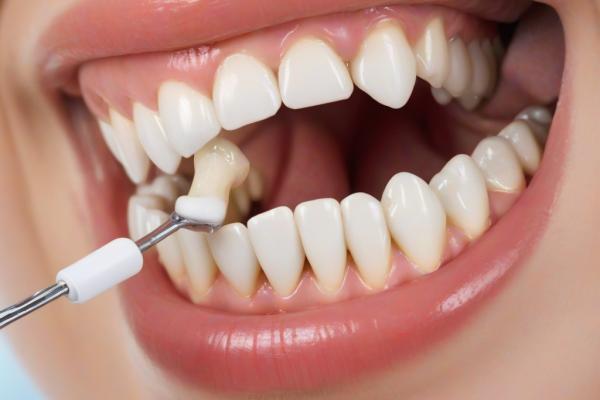 Mitos e Verdades: Canal enfraquece o dente?